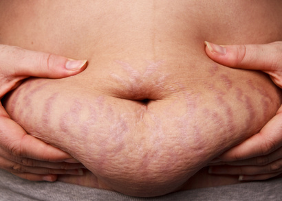 stretch marks information